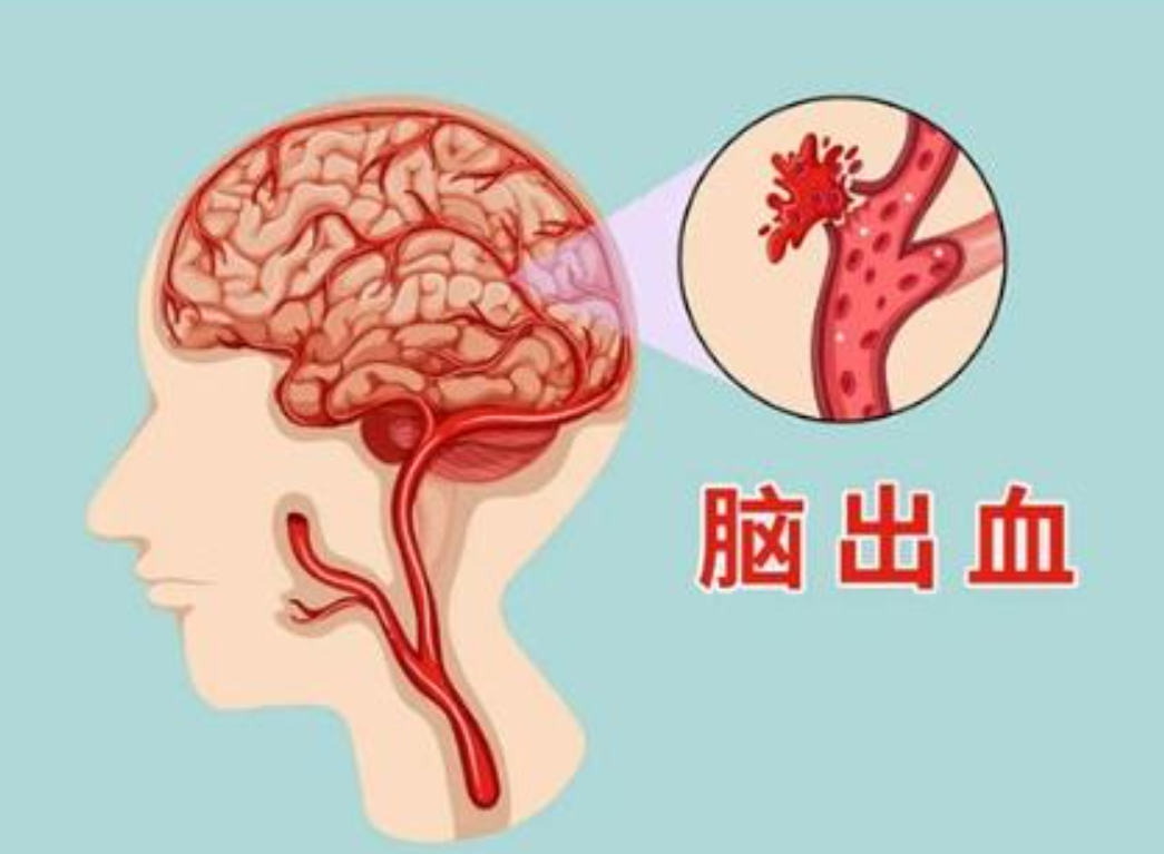 什么是脑出血的早期症状和预警信号？(图1)