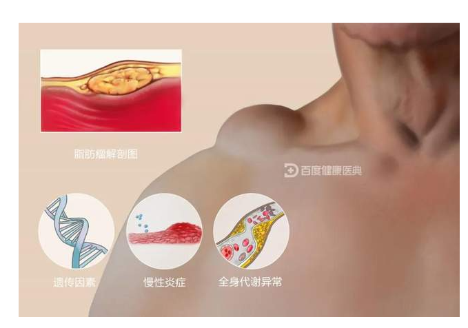 体检超声报告中此“瘤”非彼瘤(图3)