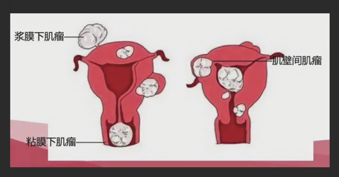 体检超声报告中此“瘤”非彼瘤(图4)