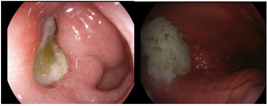 除了肚子疼，这些信号别忽视！消化性溃疡的“隐秘”症状(图6)