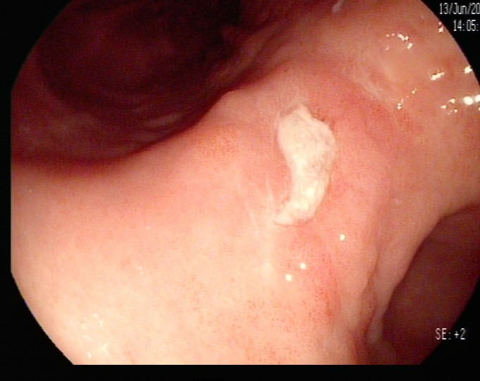 除了肚子疼，这些信号别忽视！消化性溃疡的“隐秘”症状(图7)