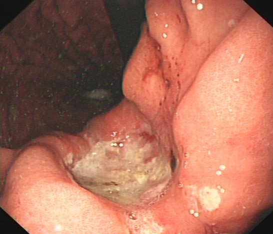 除了肚子疼，这些信号别忽视！消化性溃疡的“隐秘”症状(图5)