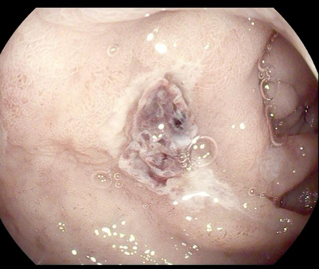 除了肚子疼，这些信号别忽视！消化性溃疡的“隐秘”症状(图9)