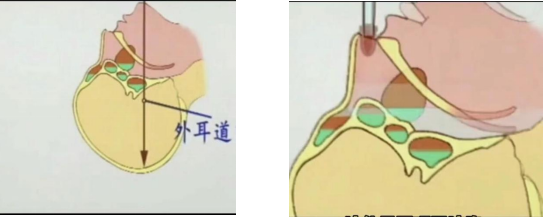 解锁大鼻孔如何配合鼻负压置换技术?(图3) 解锁大鼻孔如何配合鼻负压置换技术?(图3)