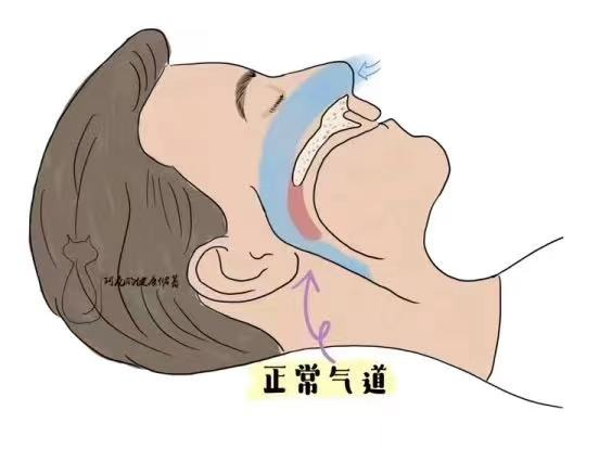 解锁大鼻孔如何配合鼻负压置换技术?(图9) 解锁大鼻孔如何配合鼻负压置换技术?(图9)