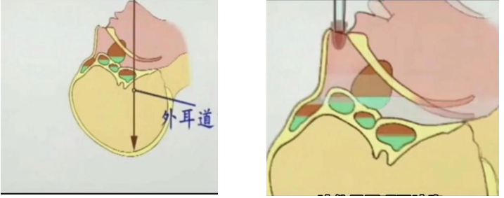 解锁大鼻孔如何配合鼻负压置换技术?(图3)