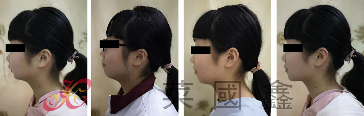 儿童早期矫治的选择和误区(图1)