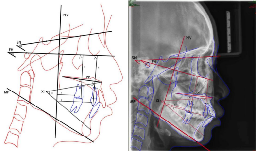 儿童早期矫治的选择和误区(图2) 儿童早期矫治的选择和误区(图2)