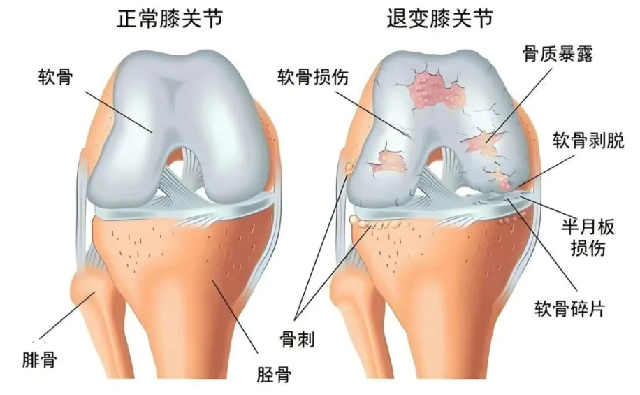 且行且珍“膝!膝盖痛千万别硬抗!(图1) 且行且珍“膝!膝盖痛千万别硬抗!(图1)