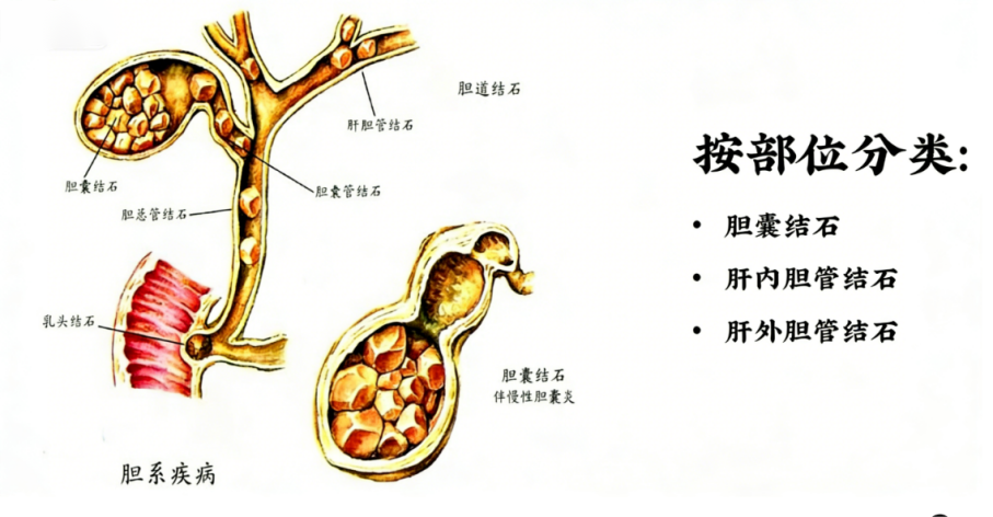 走进胆石症：小石头可能引发“大问题”(图1)